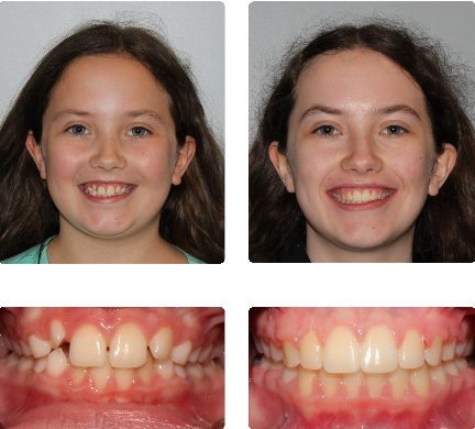 young patient before and after braces