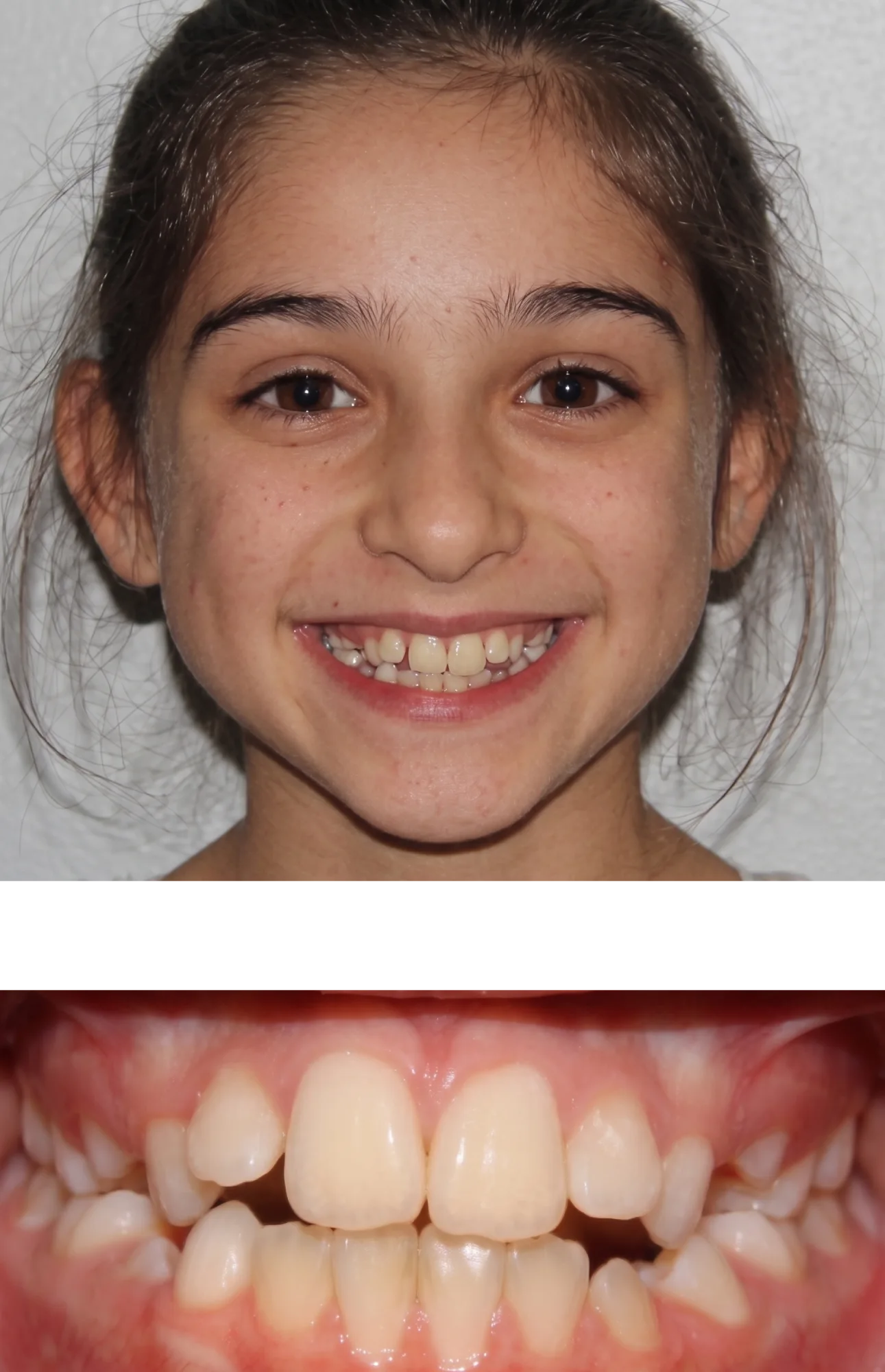 Before Orthodontic Treatment